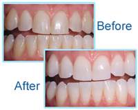 Tooth whitening